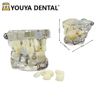 Copilăria Foioase Dinte Permanent Patologice Model cu Carii Dentare Elevi Instruire Practică Show Instrumente